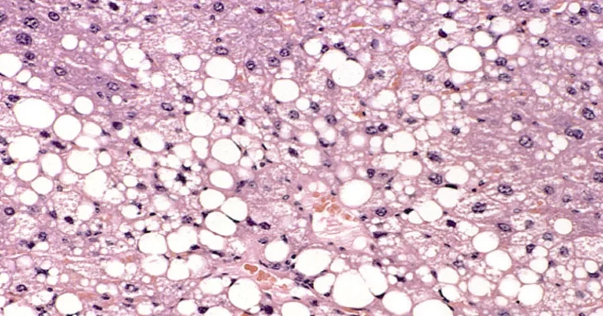 Ένζυμο προστατεύει το ήπαρ και ίσως φρενάρει την εξέλιξη της λιπώδους νόσου
